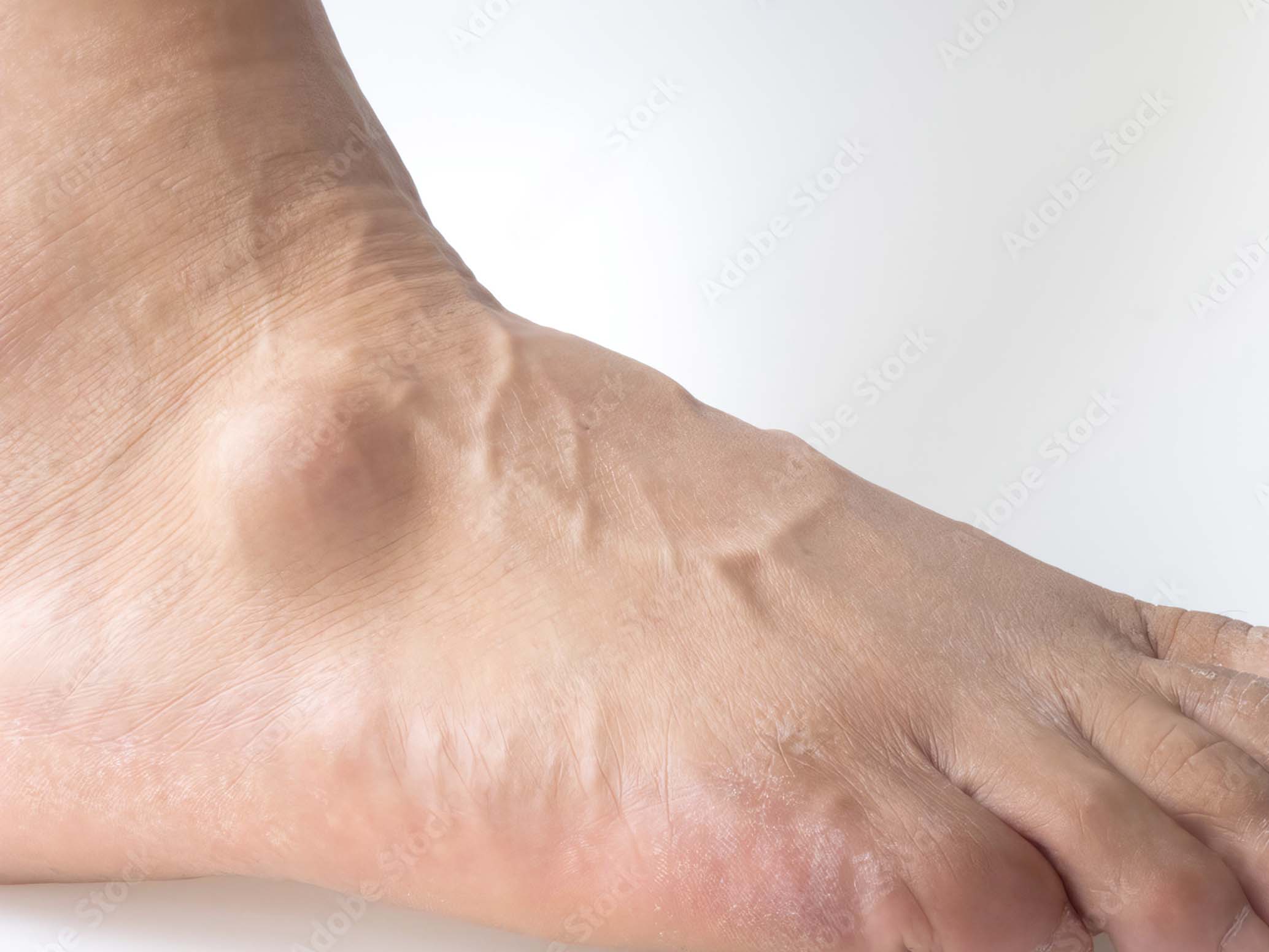 AIDA PODOLOGA-BIOMECANICA-Ganglion