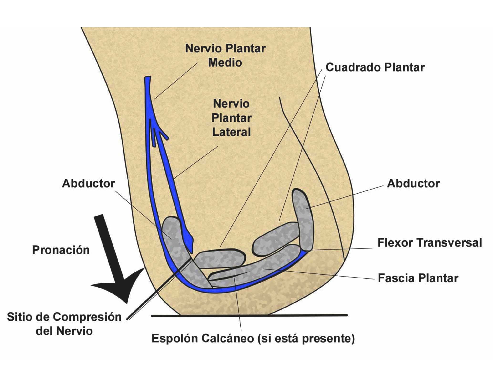 AIDA PODOLOGA-BIOMECANICA-Sindrome de Baxter